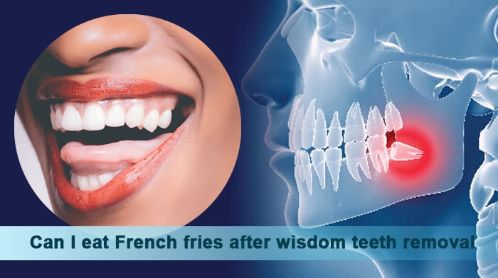 Can I eat French fries after wisdom teeth removal
