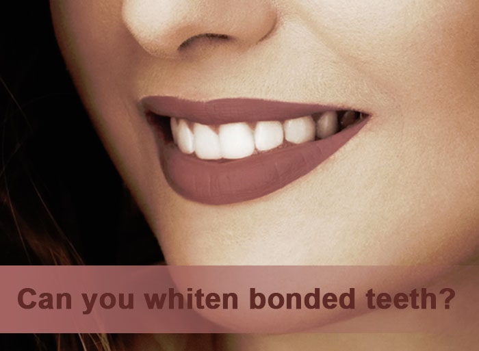 Can you whiten bonded teeth