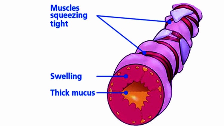 What kind of disease is asthma