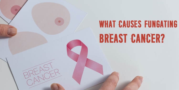 Fungating Breast Cancer